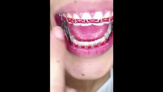 New Color Red Braces